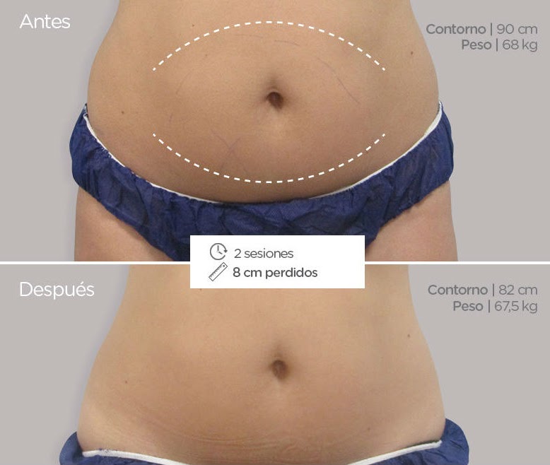 criolipolisis