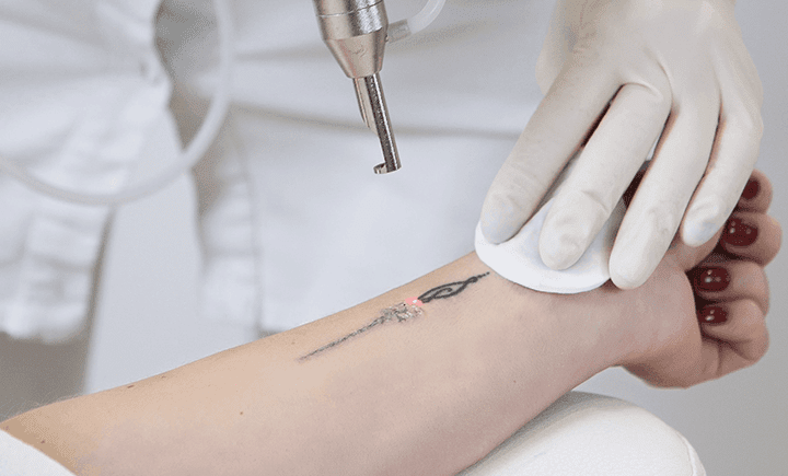 eliminación tatuajes