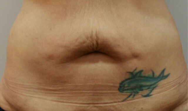 Antes